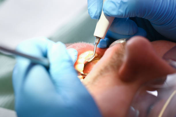 Best Emergency Dentist for Lost Fillings or Crowns in Highland, CA
